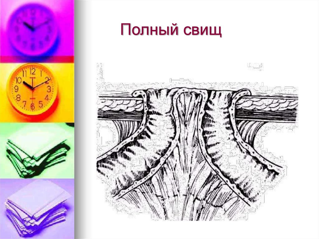 Свищ послеоперационный карта вызова