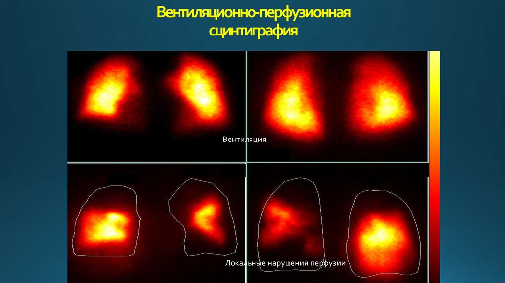 Может ли сцинтиграфия не увидеть мтс