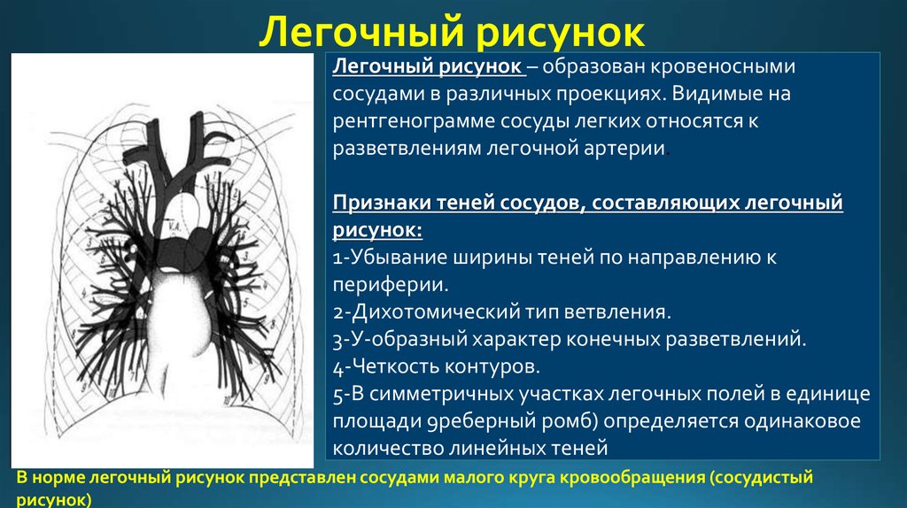 Тяжистость легочного рисунка