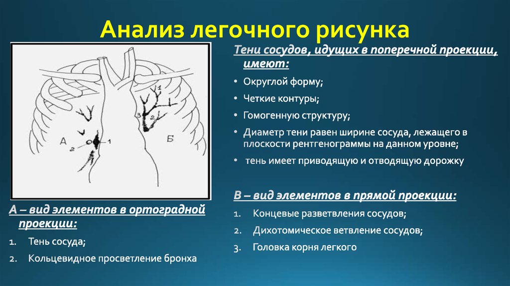 Критерии структурности легочного рисунка