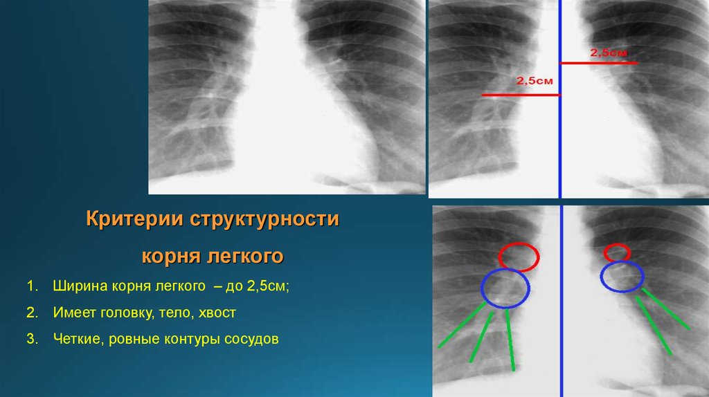 Критерии структурности легочного рисунка