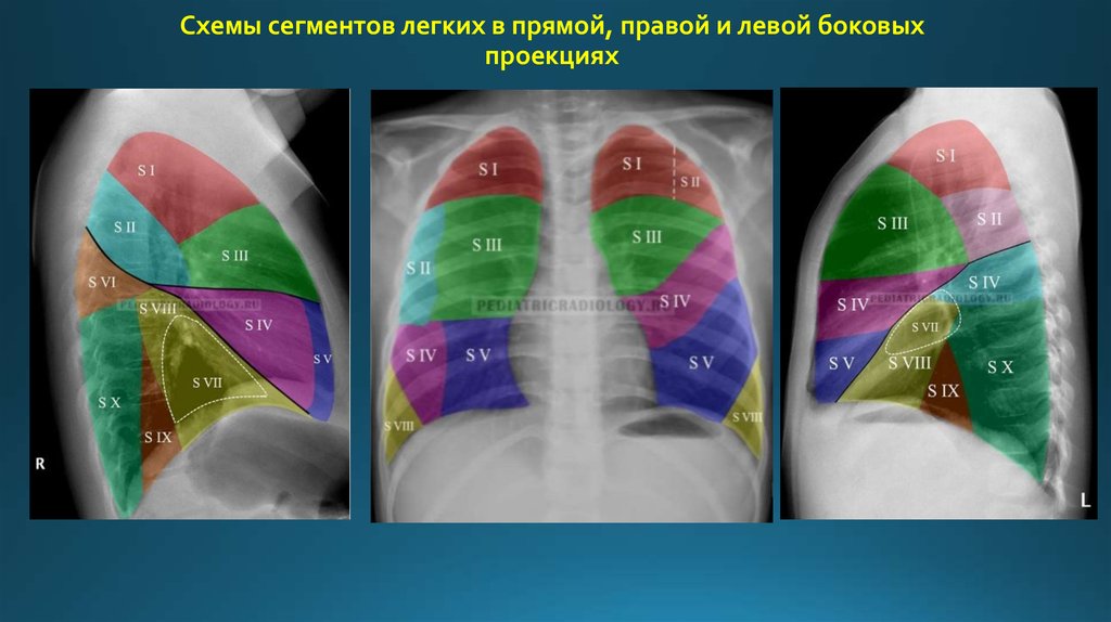 Рентген легких схема