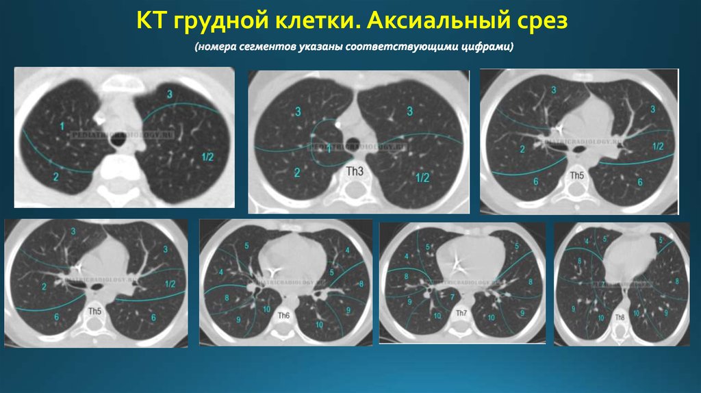 Сегментарное строение легких на рентгенограмме и схема