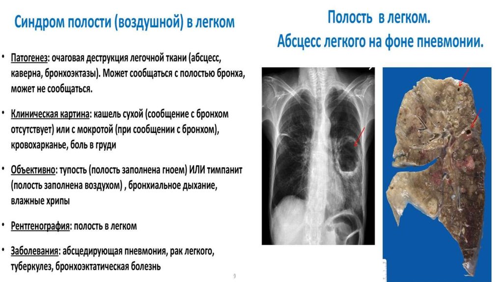 Синдром полости