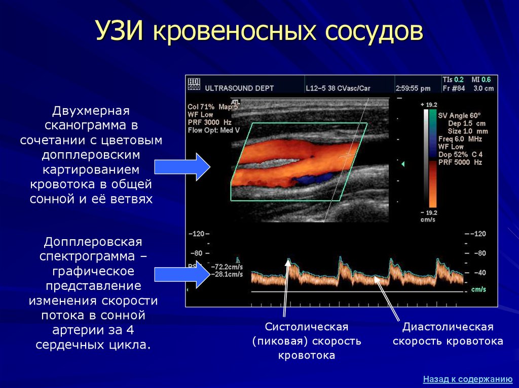 Рлт сеансы для сосудов что это. Ультразвуковое допплеровское картирование сосудов шеи. УЗИ допплерография артерий нижних конечностей. Нормы скоростей кровотока в артериях УЗИ. Мезентериальные сосуды атеросклероз.