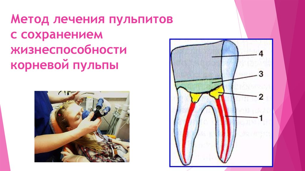 Метод сохранения жизнеспособности пульпы. Девитальная ампутация пульпы методика. Метод сохранения пульпы. Пульпит методом витальной ампутации. Биологический метод пульпит.