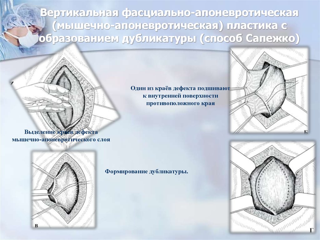 Пластика грыж. Мышечно апоневротическая пластика. Апоневротическая пластина. Пластика грыжевого дефекта по Сапежко. Методы пластики послеоперационных грыж.