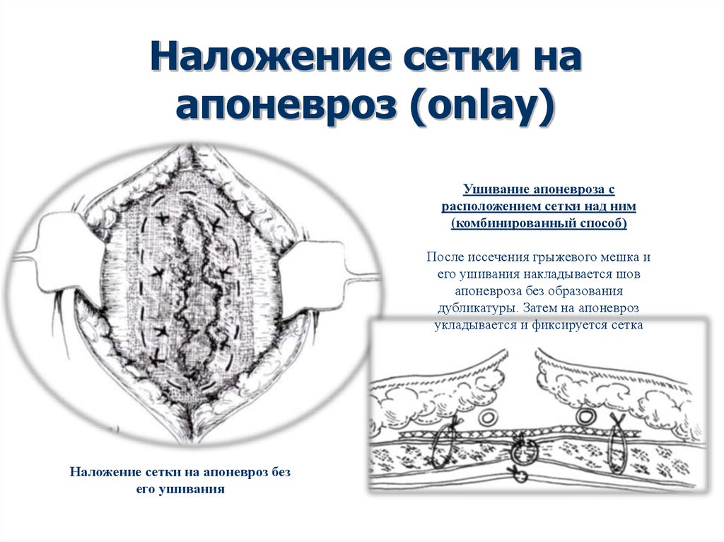 Мрт передней брюшной стенки