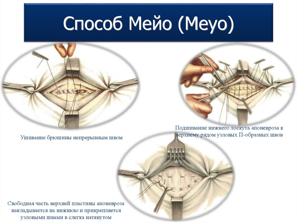 Пластика пупочной грыжи. Герниопластика пупочной грыжи по Мейо. Операция Мейо при пупочной грыже.