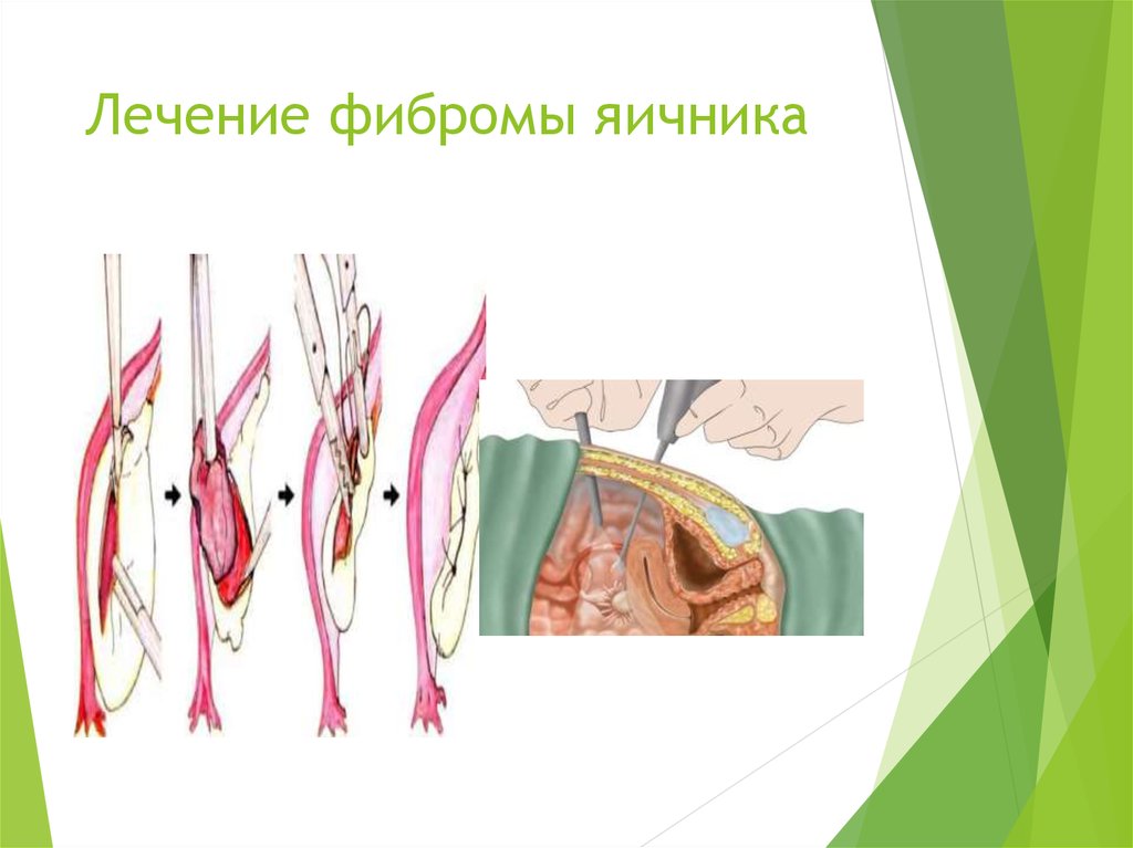Лечение фибромы яичника