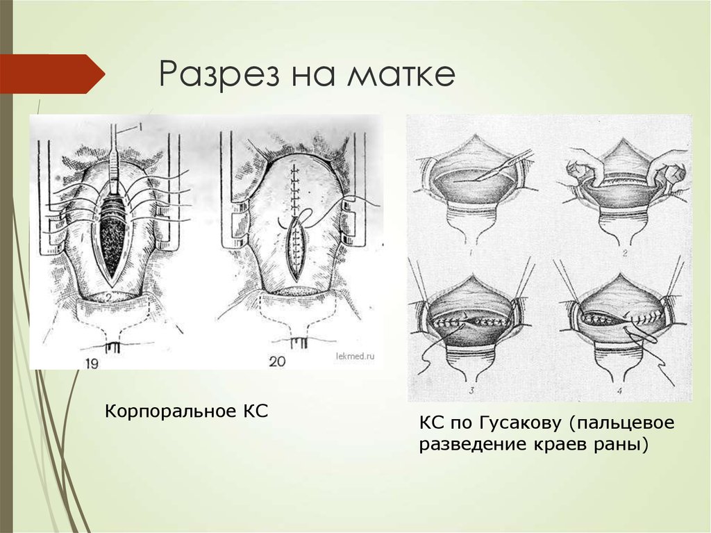 Рубец на матке после кесарева сечения фото