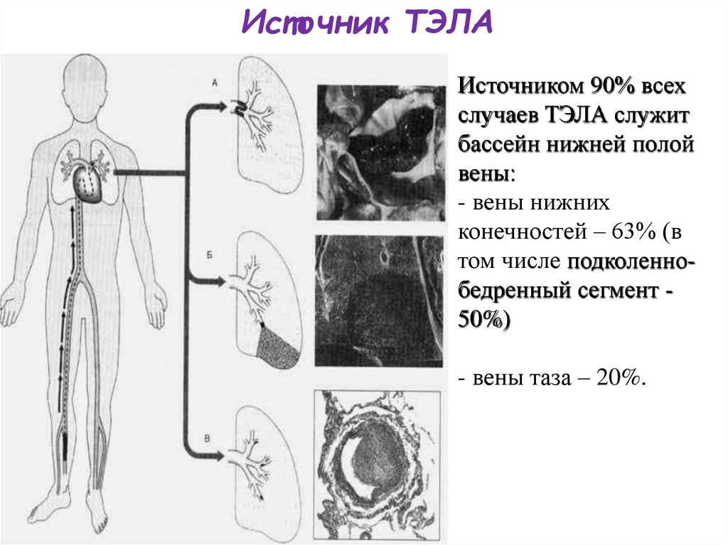 Тромбоэмболия мкб 10