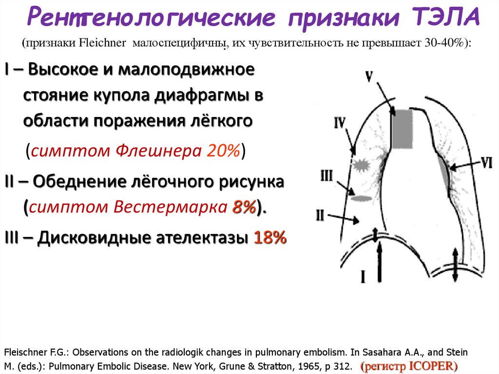 Экг признаки тэла