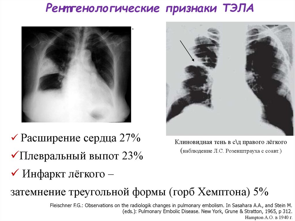 Тромбоэмболия легочной артерии пневмония. Тэла рентгенологическая картина. Тромбоэмболия на рентгене легких. Тромбоэмболия легочной артерии рентген.