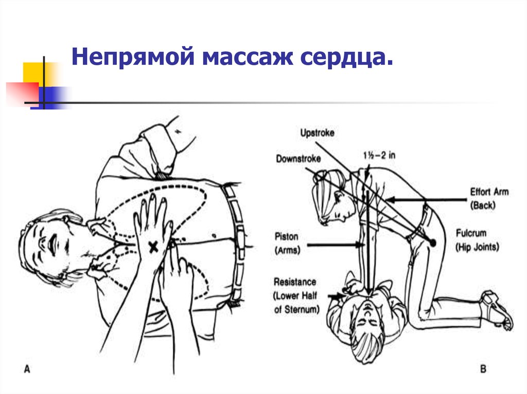 Частота непрямого массажа сердца в минуту