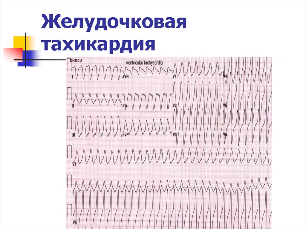 Желудочковые тахикардии презентация