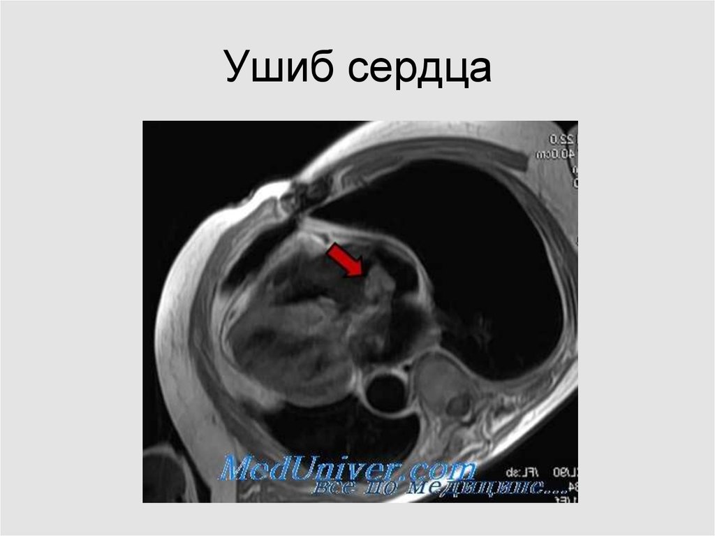 Закрытая травма сердца презентация