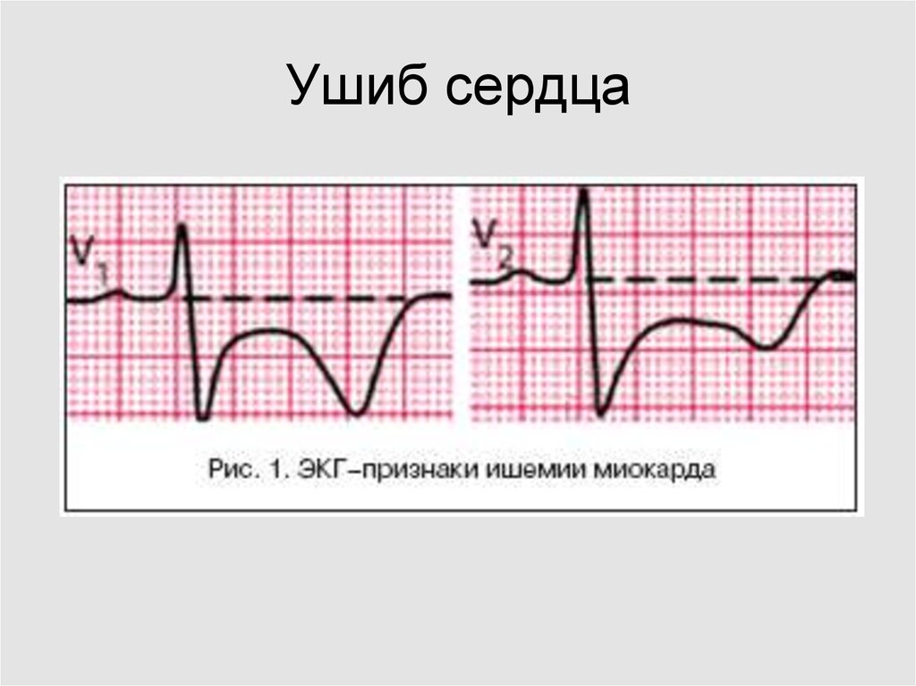 Закрытая травма сердца презентация