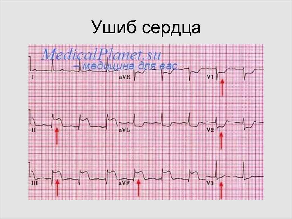 Закрытая травма сердца презентация