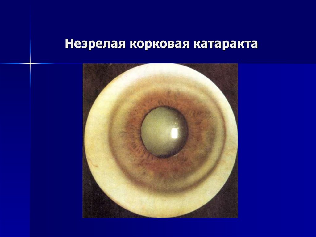 Начальная старческая катаракта. Корковая (серая) катаракта. Старческая корковая катаракта. Капсулярная врожденная катаракта. Катаракта морганиева катаракта.