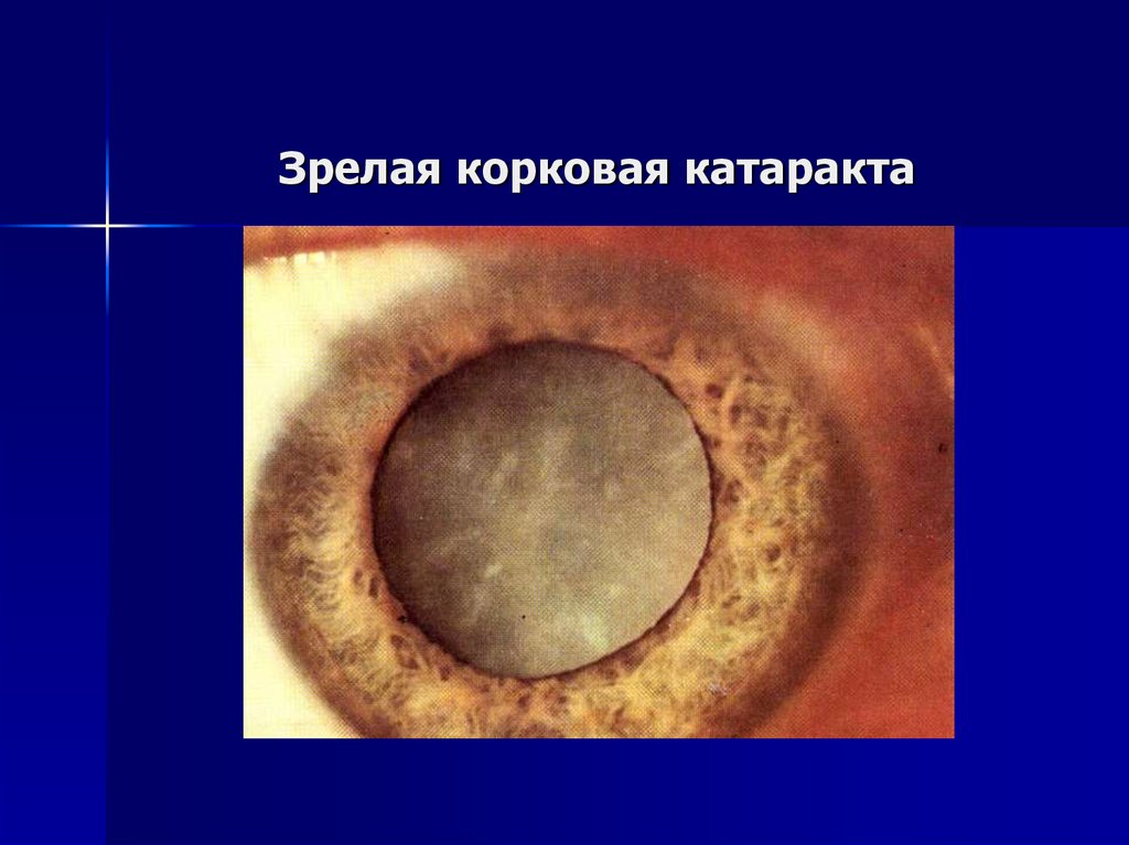 Начальная старческая катаракта. Начальная корковая катаракта. Зрелая корковая катаракта. Незрелая корковая катаракта. Корковая и ядерная катаракта.