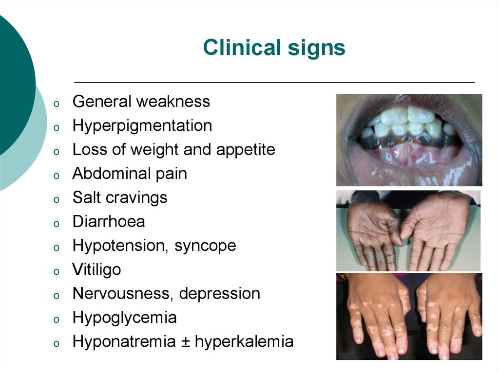 Hypocortisolism Addison's disease - online presentation