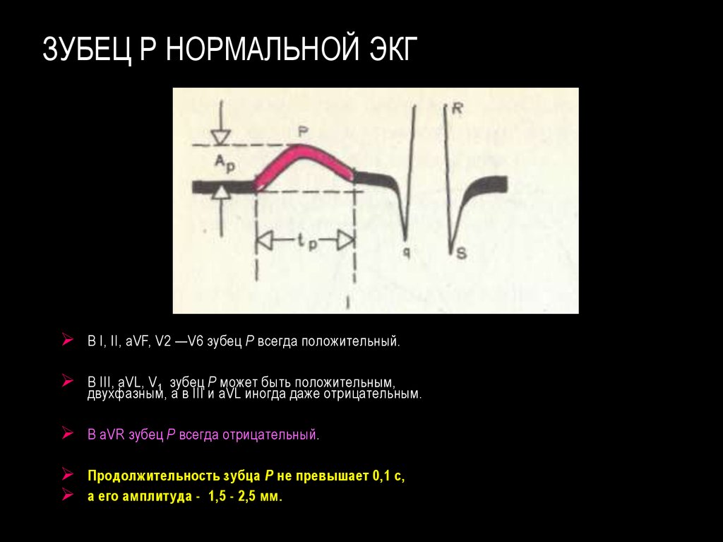 Зубцы экг. Расщепленный зубец п на ЭКГ. Зубец q II III AVF. ЭКГ v3 расщепление зубца r. Расщепление зубца q на ЭКГ.