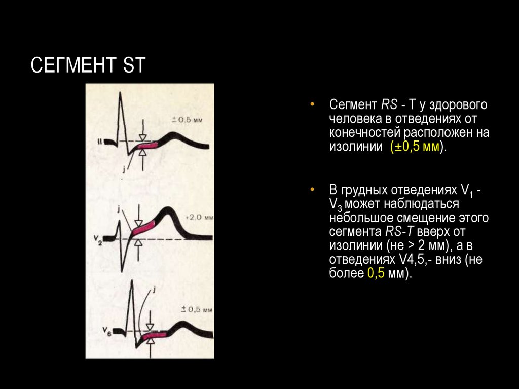 Сегменты экг