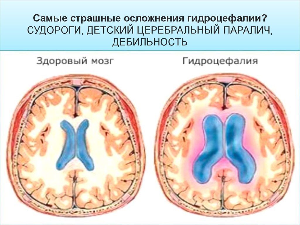 Гидроцефалия на фоне кортикальной атрофии