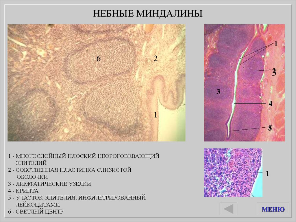 Перифиссурально узелки. Эпителий слизистой оболочки небной миндалины. Эпителий миндалин гистология. Инфильтрированный эпителий миндалины. Гистология мышечная пластинка.