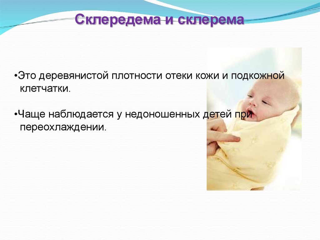 Склередема новорожденных презентация