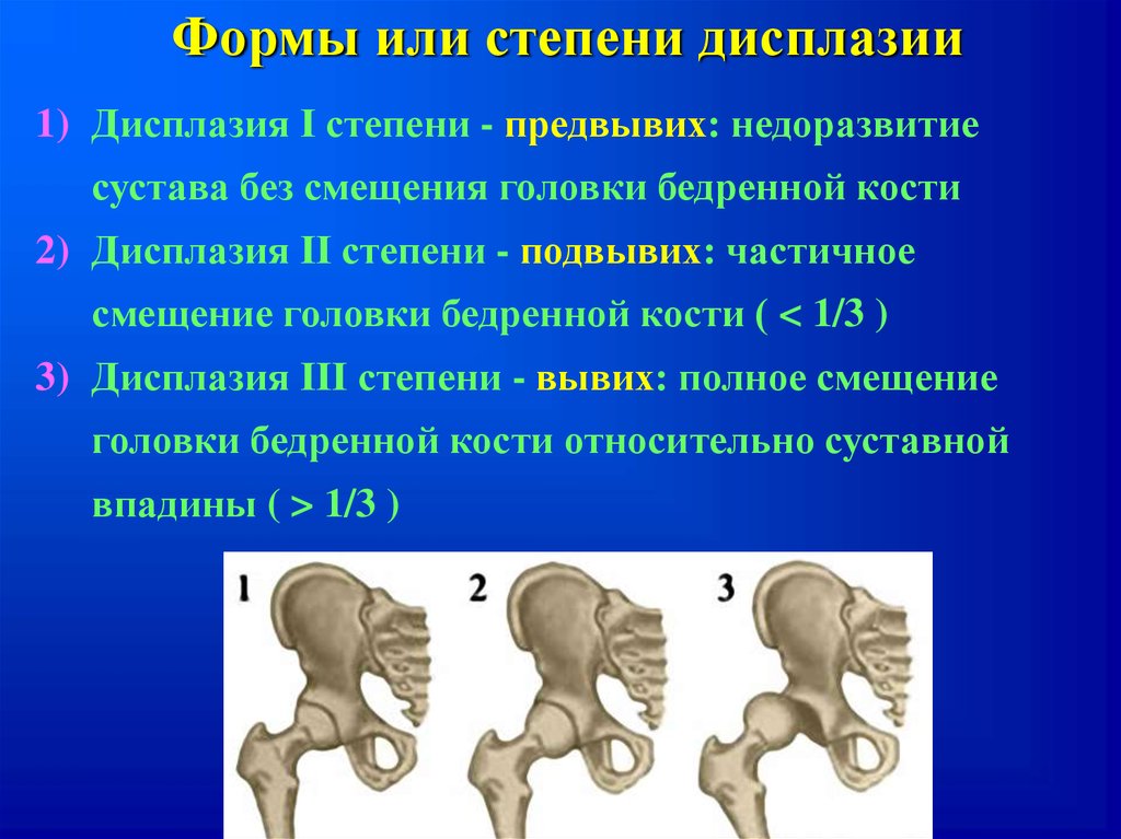 Схема врожденного вывиха бедра