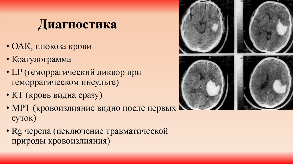 План обследования при ишемическом инсульте