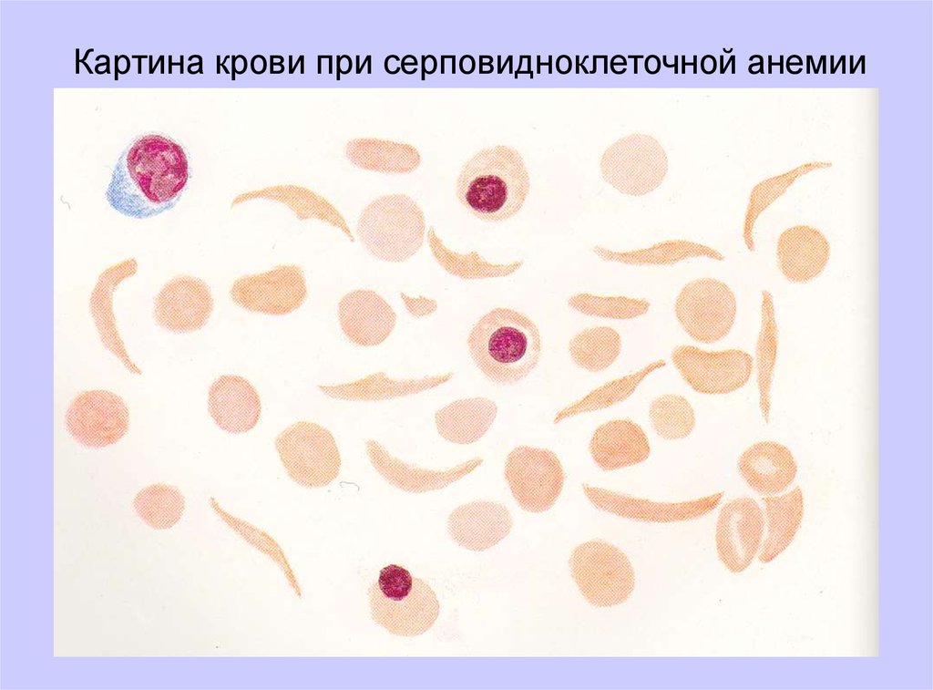 Серповидноклеточная анемия картина крови