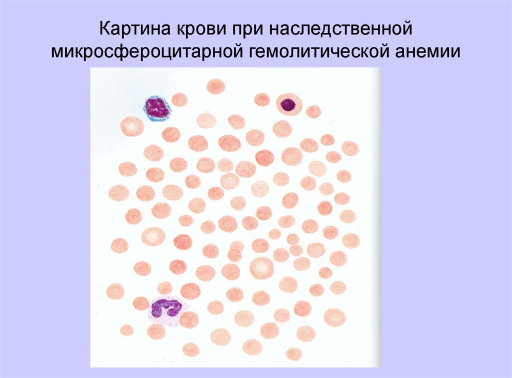 Картины анемии. Гемолитическая анемия картина крови. Микросфероцитарная анемия картина крови. Картина крови при наследственных гемолитических анемиях. Картина крови при гемолитической анемии.