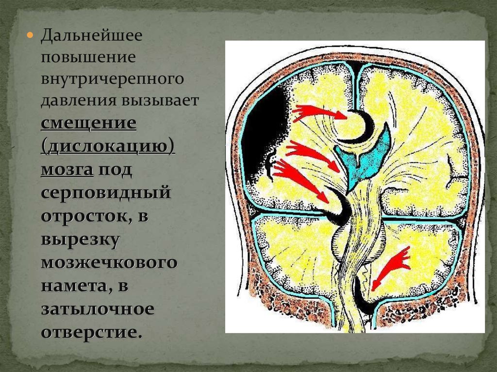 Гематома головного мозга прогноз. Под мозговым наметом. Аксиальное смещение под серповидный отросток. Фистула над наметом мозжечка. Дислокация мозга предложение.