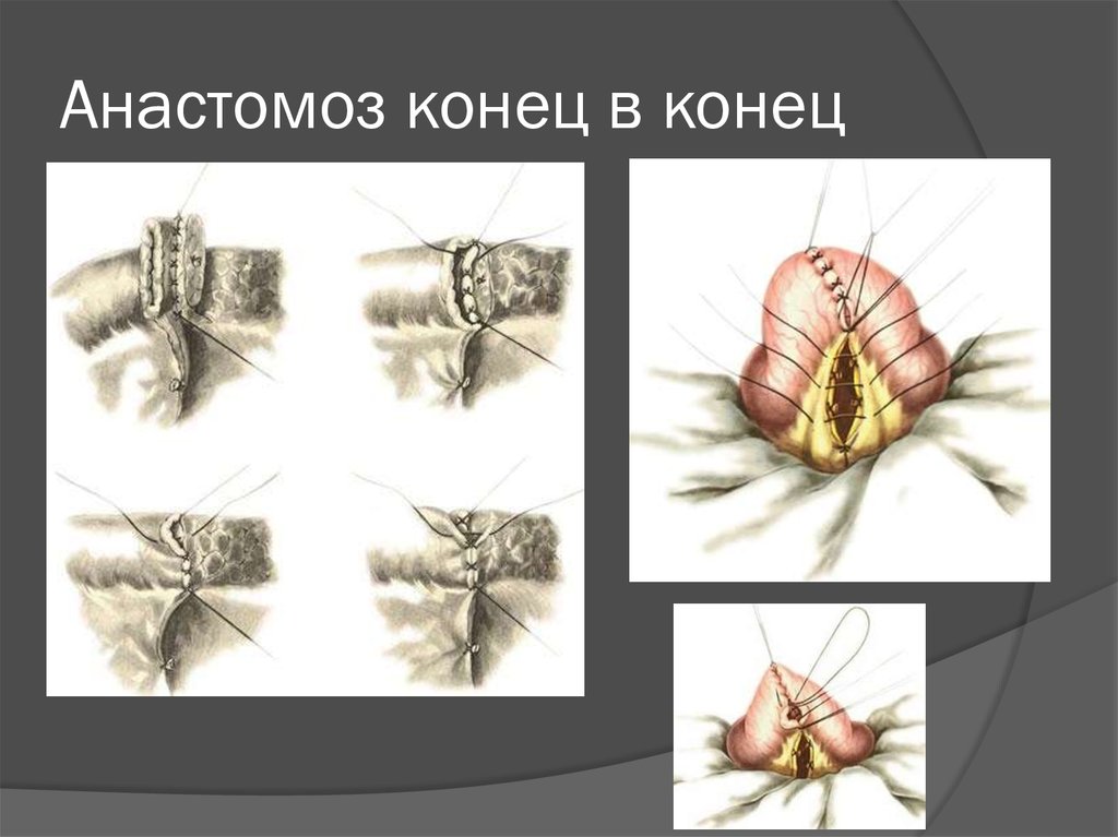 Кишечные анастомозы. Тонкокишечный анастомоз конец в конец. Кишечный анастомоз конец в конец. Анастомоз конец в конец швы. Сигморектальный анастомоз конец в конец.