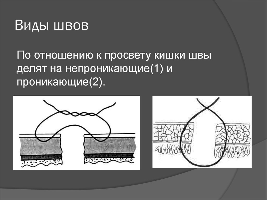 Кишечный шов презентация