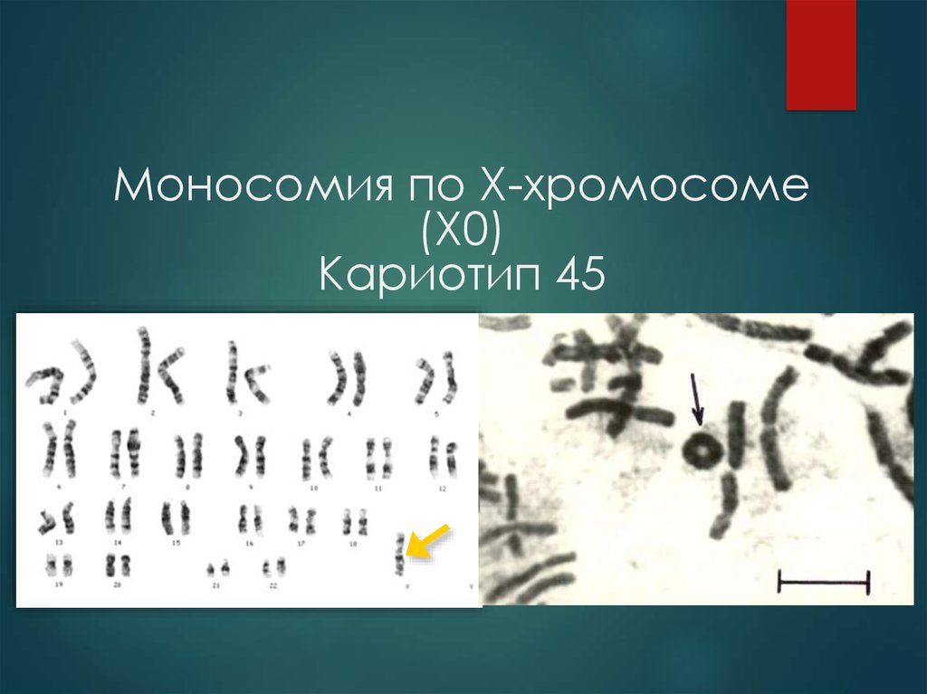 Кариотип 45. Кариотип с моносомией по хромосоме 21. Моносомия по х-хромосоме кариотип.