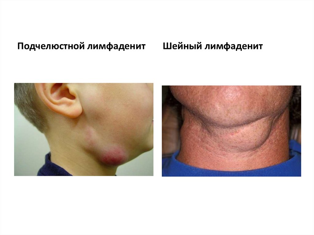 Лимфаденит лечение и диагностика в Dekamedical клинике в Москве