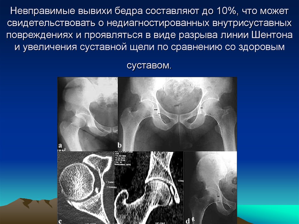 Вывих бедра презентация