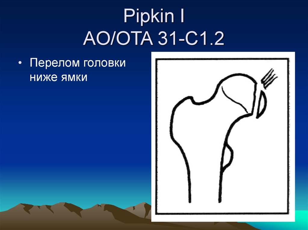 Pipkin I AO/OTA 31-C1.2