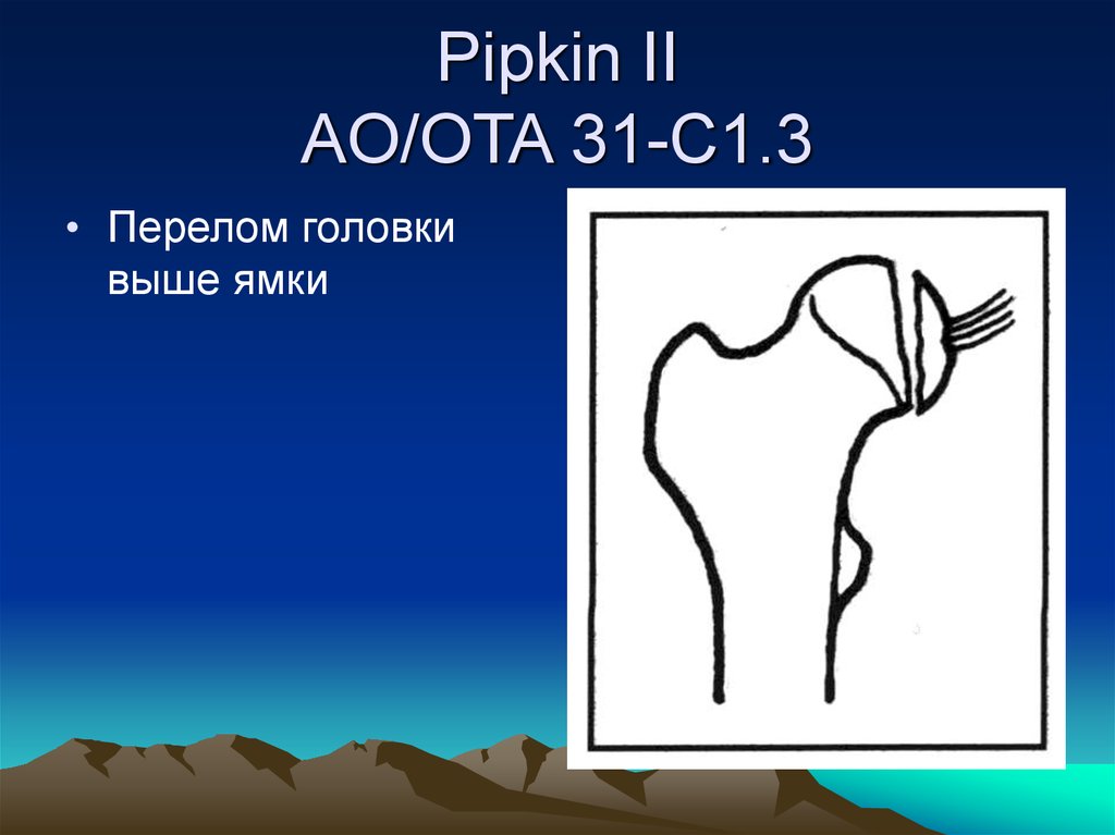Pipkin II AO/OTA 31-C1.3