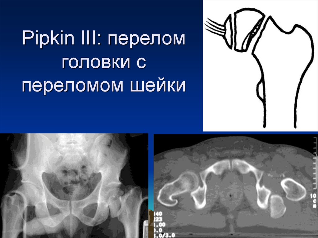Pipkin III: перелом головки с переломом шейки