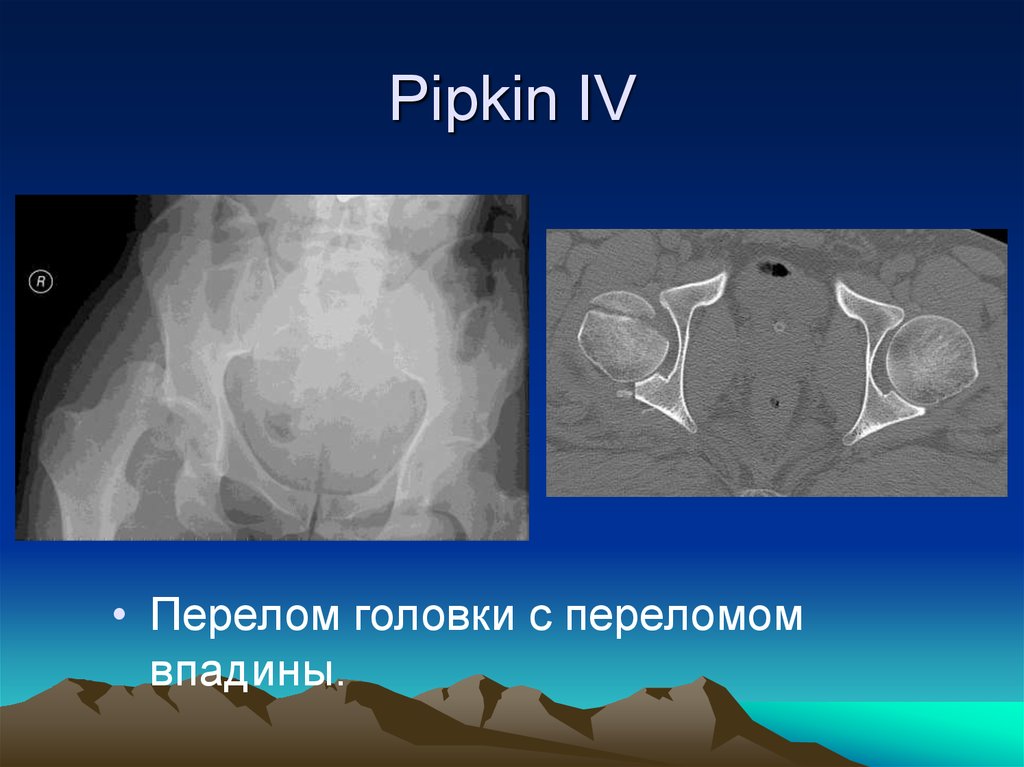 Pipkin IV