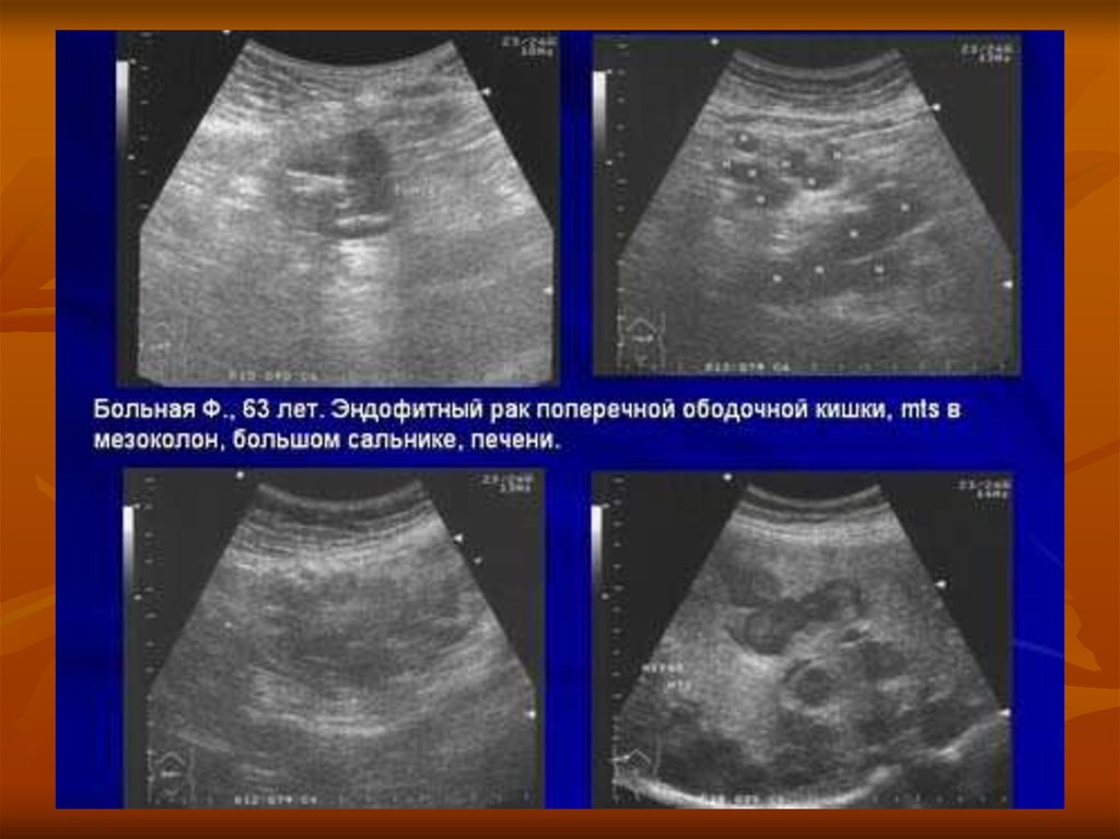 Узи обнаруживает рак. Опухоль брюшной полости на УЗИ. Объемное образование брюшной полости УЗИ.