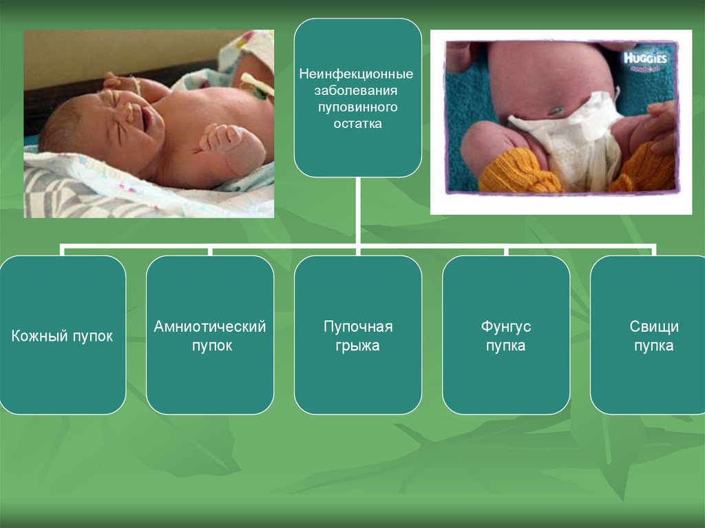 Заболевания новорожденных. Неинфекционные заболевания пупочной ранки у новорожденных. Неинфекционные заболевания пупка. Неинфекционныезаболевани новорожденных. Неинфекционные заболевания кожи и пупка у новорожденных.