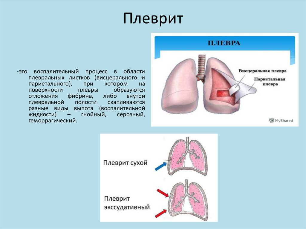 Формы плеврита