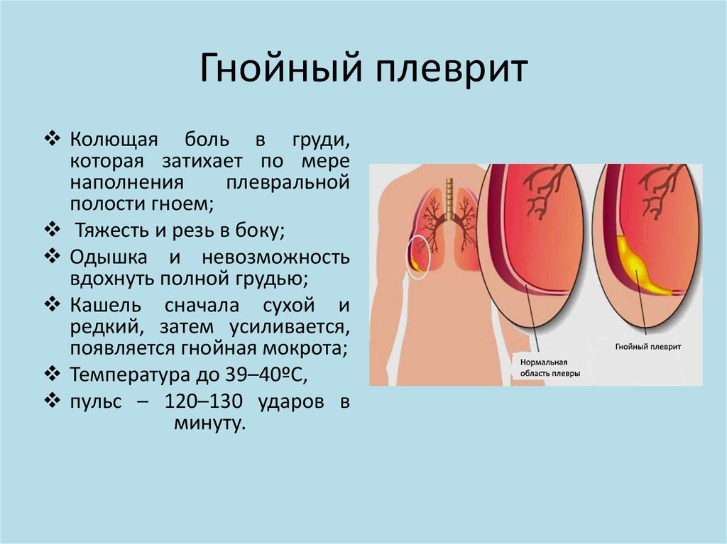 Стадии плеврита