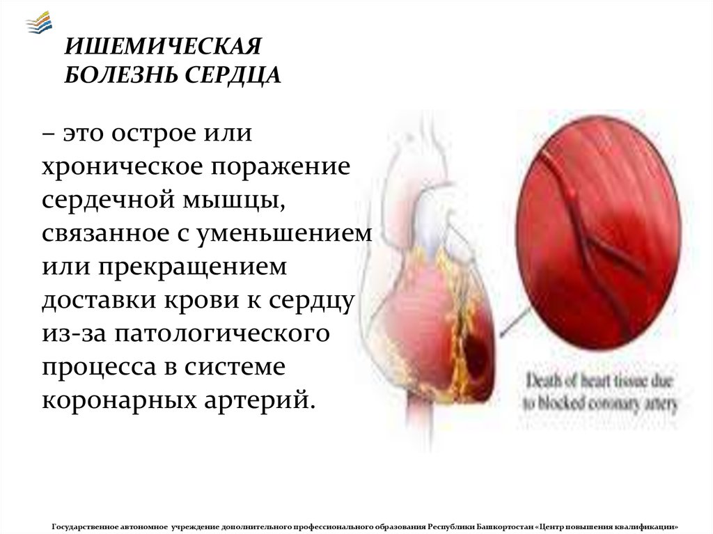 Ишемия крови. Ишемическое заболевание сердца. Острая ишемическая болезнь сердца.